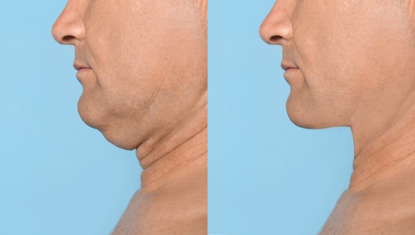 Which Non-Surgical Treatments Work Best for Jowls and Loose Skin Radlett?