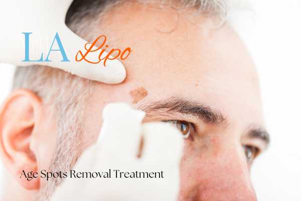 What Are the Most Effective Treatments for Age Spots Radlett?