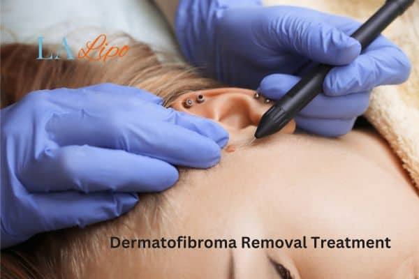 Dermatofibroma Removal Treatment Radlett