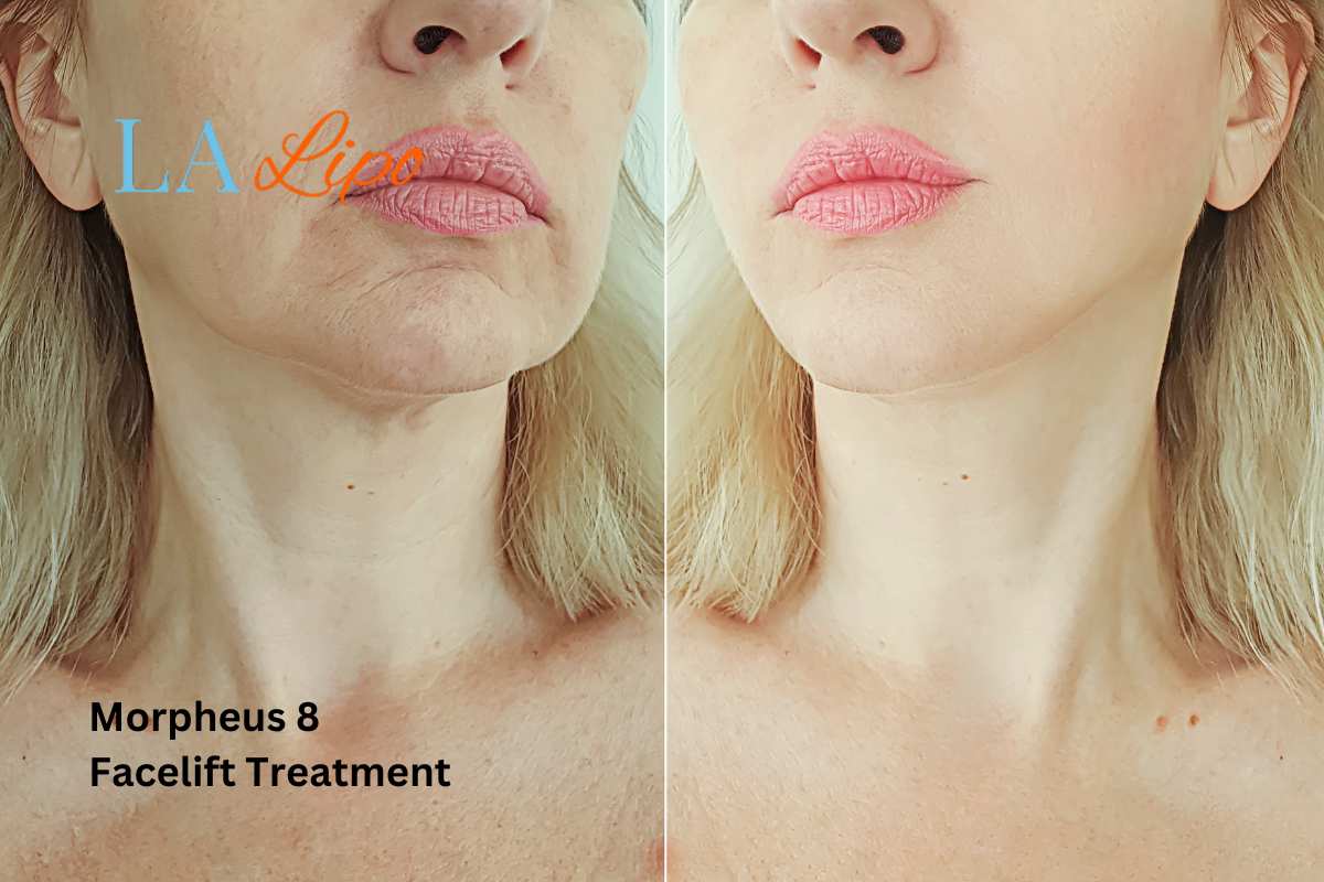 Turn back time with Morpheus8 Treatment Radlett