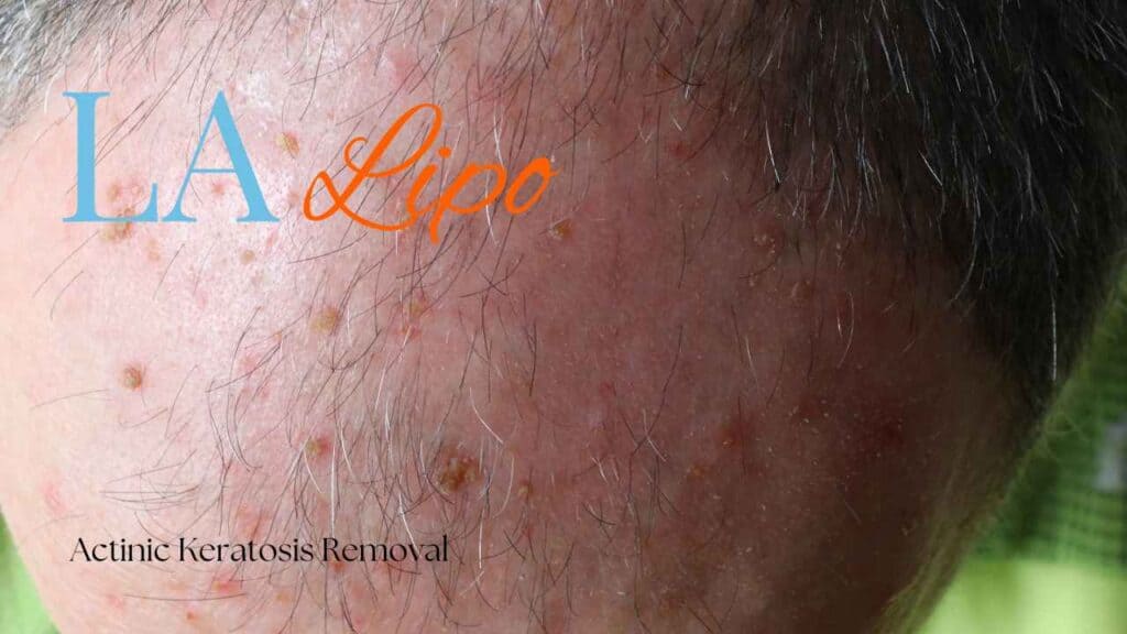 actinic keratosis