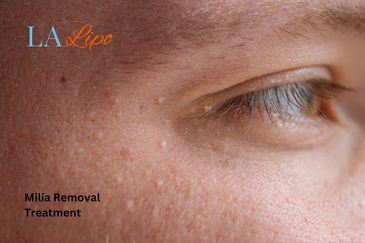 Cryopen Milia Removal: Is It the Easiest and Safest Option Radlett?