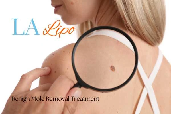 Why getting moles removed Radlett can boost your confidence!