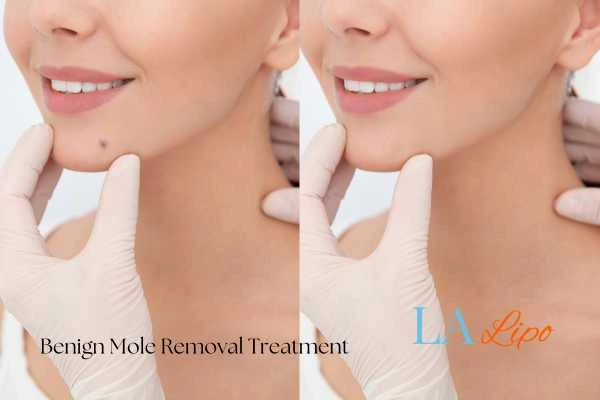 woman's before and after mole removal Radlett results
