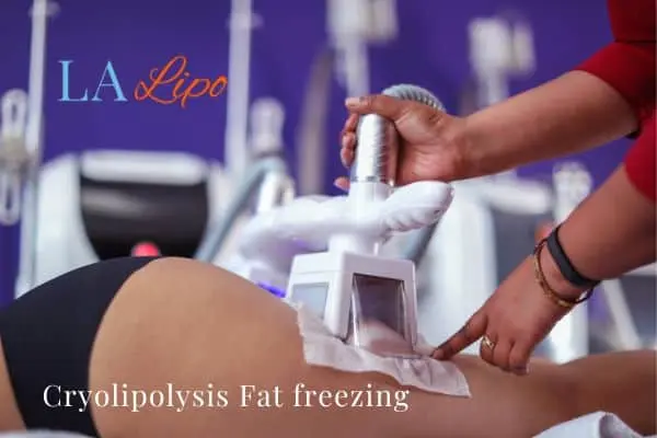 women getting fat freezing Radlett