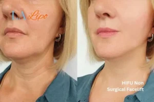 hi-fu for wrinkles Radlett before and after results