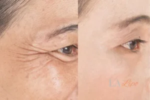 Before and after results of woman - HI-fu wrinkles reduction treatment Radlett