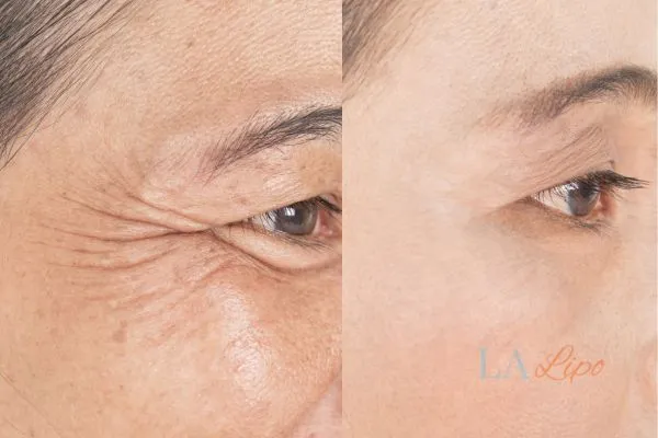 Before and after results of woman - HI-fu wrinkles reduction treatment Radlett