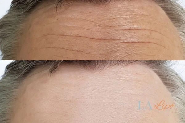 results of HIFU Radlett on mans forehead to help reduce lines and wrinkles