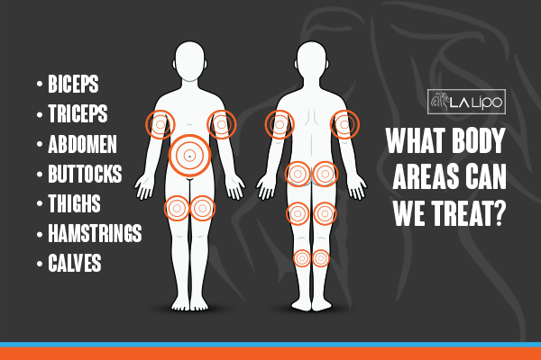Graphic to show areas you can have LA-EMS Body Sculpting Radlett treatment.