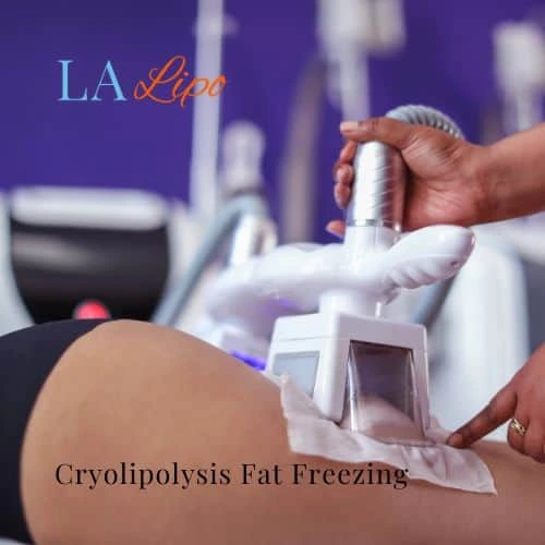 fat freezing - Cryolipolysis Radlett