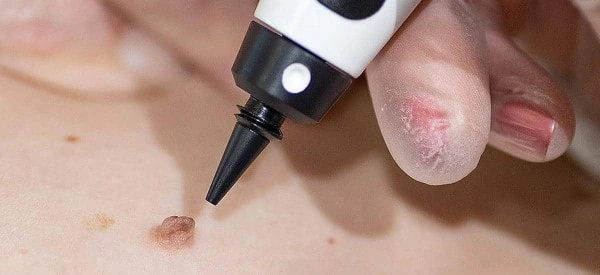skin tag removal using cryopen Radlett