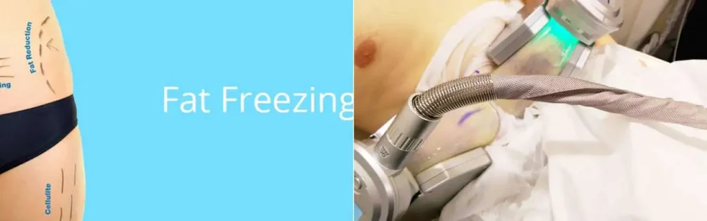 multi areas of a persons body having coolsculpting Radlett treatment