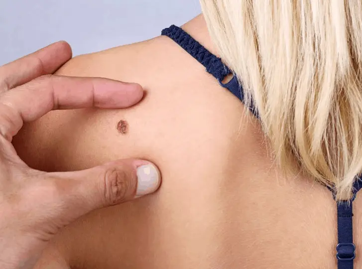 woman having mole removal Radlett consultation before treatment.