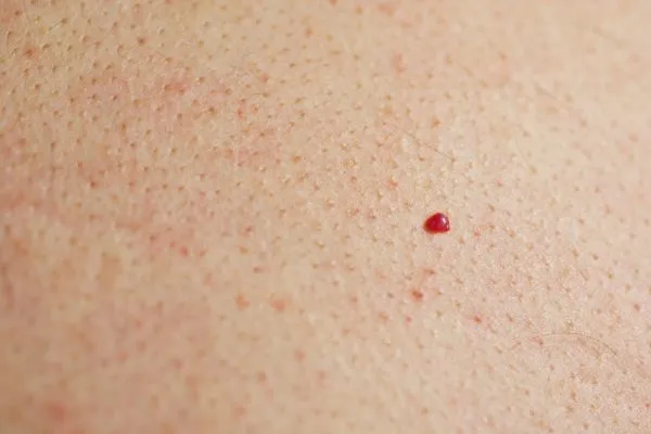 close up of a cherry angioma Radlett