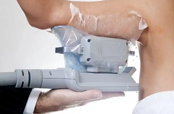 Picture of fat freezing Radlett on the upper arms.