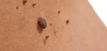 image of a skin tag Radlett