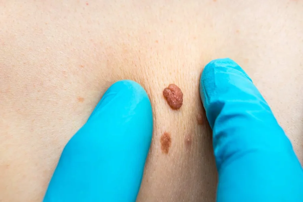 Consultant examining a skin tag Radlett
