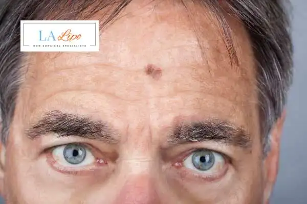 Solar Lentigo Removal Radlett image of man with mark on his forehead