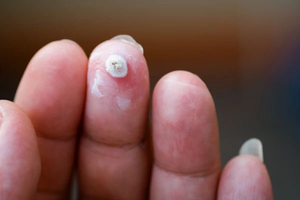 wart on person finger - cryotherapy to treat from LA LIPO Radlett
