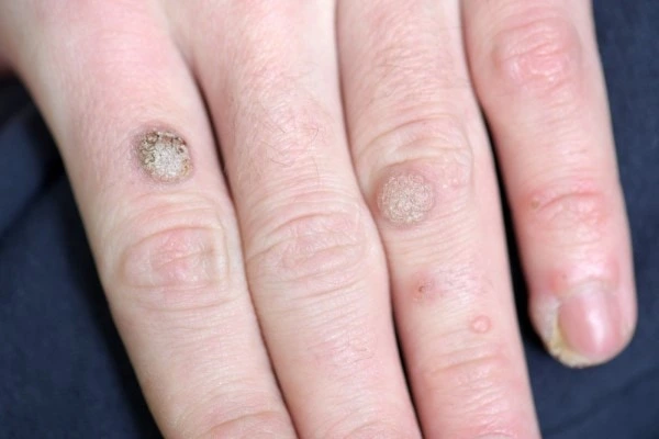 photo of warts on person hand - see wart removal Radlett from LA LIPO