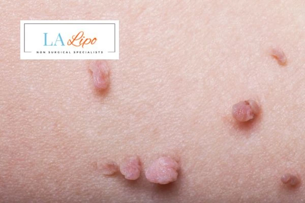 Does cryopen skin tag removal Radlett hurt? Find out now call our team today!