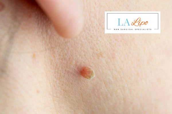Book skin tag removal Radlett today speak to our team now!