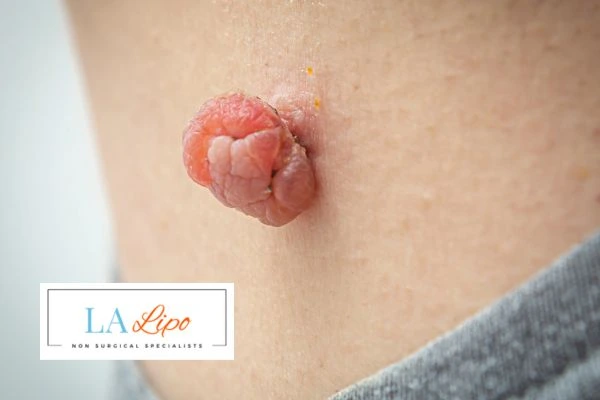 Interested in skin tag removal Radlett? Concerned about the pain? Find out more today!