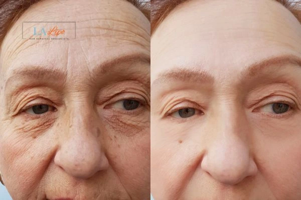 The powerful benefits of Morpheus8 Treatment Radlett - Call Our team today!