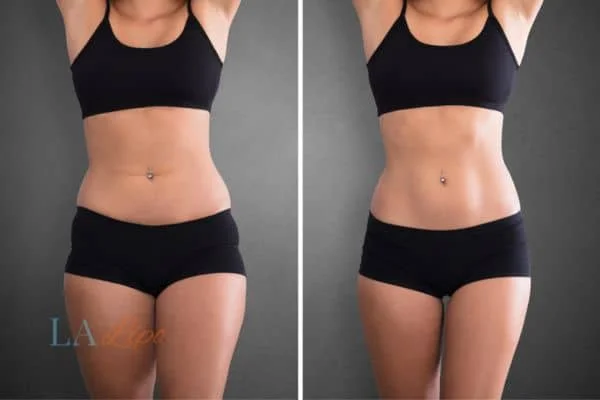 before and after results of non-surgical treatment to help a woman's body image and mental health Radlett