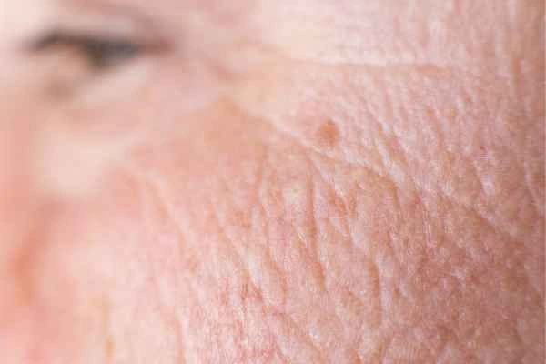 close up picture of a woman's face showing an age spot Radlett
