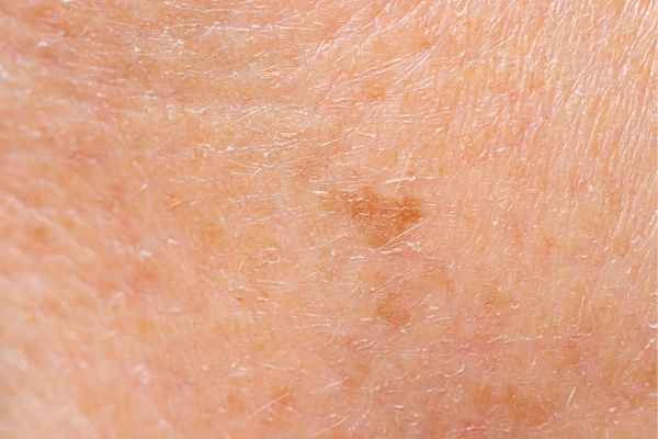 close up picture of age spots Radlett