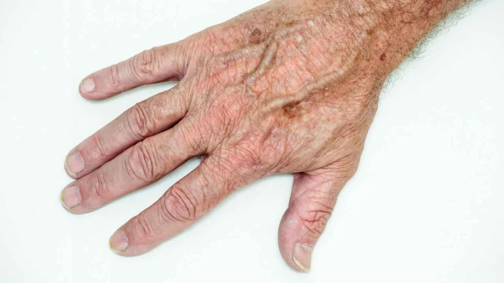 Male hand showing age spot Radlett
