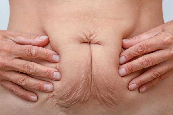 Image of a woman's stomach with loose skin - example of skin tightening Radlett options