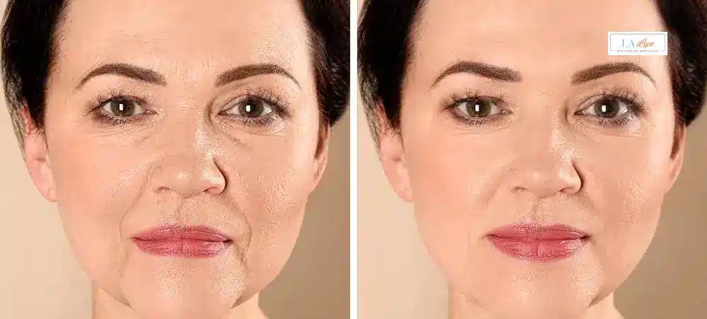 How Long Does It Take to See Results and How Long Do They Last Radlett?