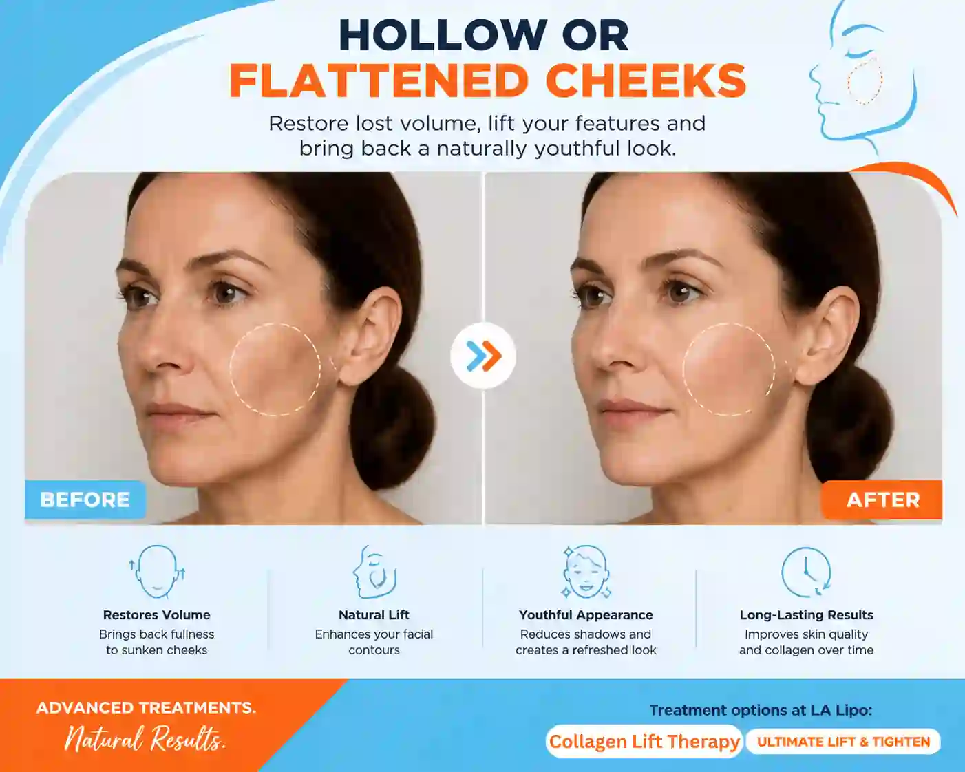 Sign #4: Hollow or Flattened Cheeks Radlett